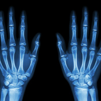 Calls for a review of personal injury awards in light of cost-of-living crisis