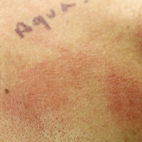 Consumo gusto - Alergias e intolerancias - 25/11/25