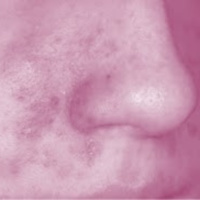 006 Dermatitis seborreica