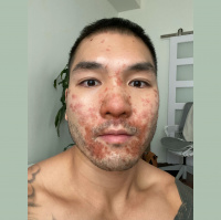 California Man Details Monkeypox Experience