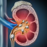 Episode #132 - Stepping Stones: Advancing Kidney Stone Disease Research