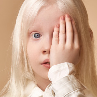 Episode #96 - All About Albinism