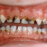 Episode 6: Dont let this happen to your childs mouth!