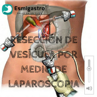 Resección de vesícula por medio de laparoscopia