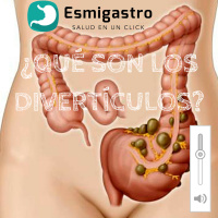 ¿Qué son los divertículos?