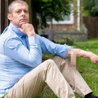 Man Loses Penis To Infection, Doctor Builds New One On Arm