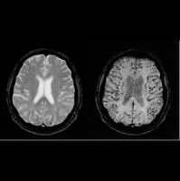 The Alzheimers Copernicus Problem, Part 1