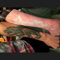 Rethinking Ink: Lasers, Tattoo Removal, and Second Chances