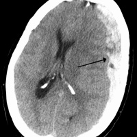 Reversing Anticoags In Intracranial Bleed
