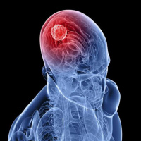 La encefalitis, causas síntomas y tratamiento