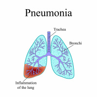 Pneumonia: Prevention is Better than Treatment