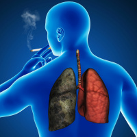 African-Americans and Lung Cancer