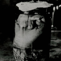 Amputaciones, miembros perdidos y prótesis