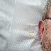 Should You Try Acupuncture? with Dr. Nikki Kelly