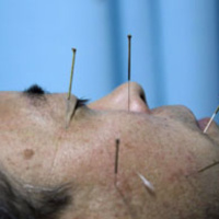 Los implant files y la acupuntura