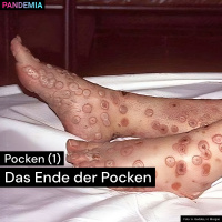 Pocken (1) | Das Ende der Pocken