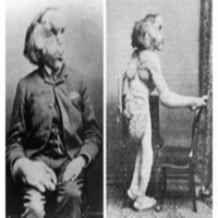 RUMBO INFINITO 09-05-2014 Joseph Merrick: la lucha del Hombre Elefante