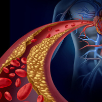 Aterosclerosis