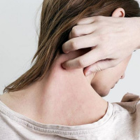 ¿Tienes enrojecimiento en la piel? ¡Cuidado! podría padecer Psiorasis