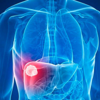 Cáncer de Hígado