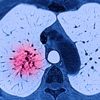 Lungenkrebs, Malaria, Parkinson: Hier könnte es 2024 Fortschritte geben