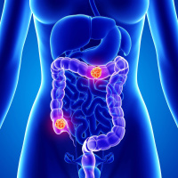 Darmkrebs: Aufgenommenes Mikroplastik könnte Tumoren begünstigen