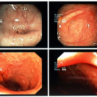So kann eine Darmspiegelung Darmkrebs verhindern