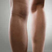 Trombose: fatores de risco e possibilidades de tratamento