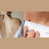 The ABCDE To Minding Your Skin This Summer