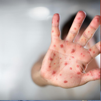 How to spot measles and what to do if you’re sick