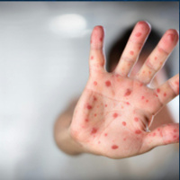 With chickenpox on the rise, how can parents treat it?