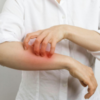 What is scabies and why are outbreaks rising?