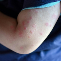 What is Urticaria or better know as nettle rash?