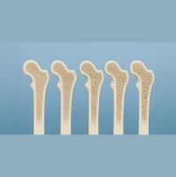 Giornata Mondiale dellOsteoporosi