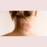 Dermatite atopica negli adulti e nei bambini