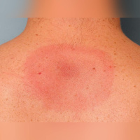 Do we have proper treatment for Lyme disease in Ireland?