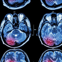 CBD zur Behandlung von Hirntumoren