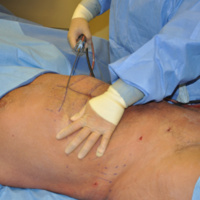 6 Pack ABS SURGERY For Lazy BASTARDS In ONE DAY!