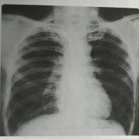 whole tumor histogram image processing