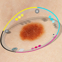 Inteligencia artificial para la detección del cáncer de piel