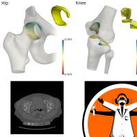 A new method of diagnosing osteoarthritis