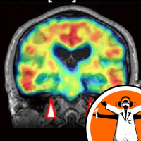 Tackling the tangles in Alzheimers Disease