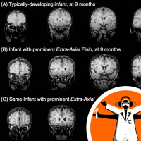 Brain scans to improve autism diagnosis