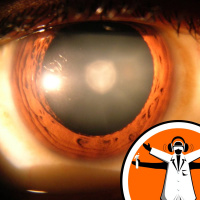 Eye drops to treat cataracts