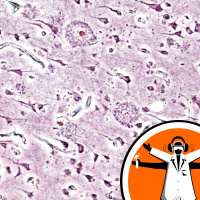 Alzheimers on the Mind