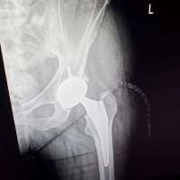 Post Surgery  Podcast Update!