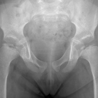 I Never Did Have Herpes - Tolerating Torturous Therapies For A Childhood Disease