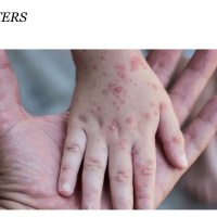 Monkey pox out break