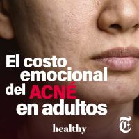 Episodio 49: El costo emocional del acné adulto