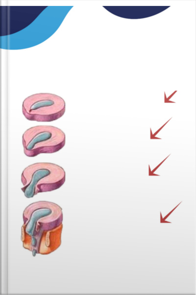 Hernia Discal - Bônus 1